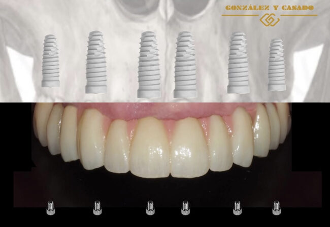 mantenimiento dental de los implantes en madrid centro