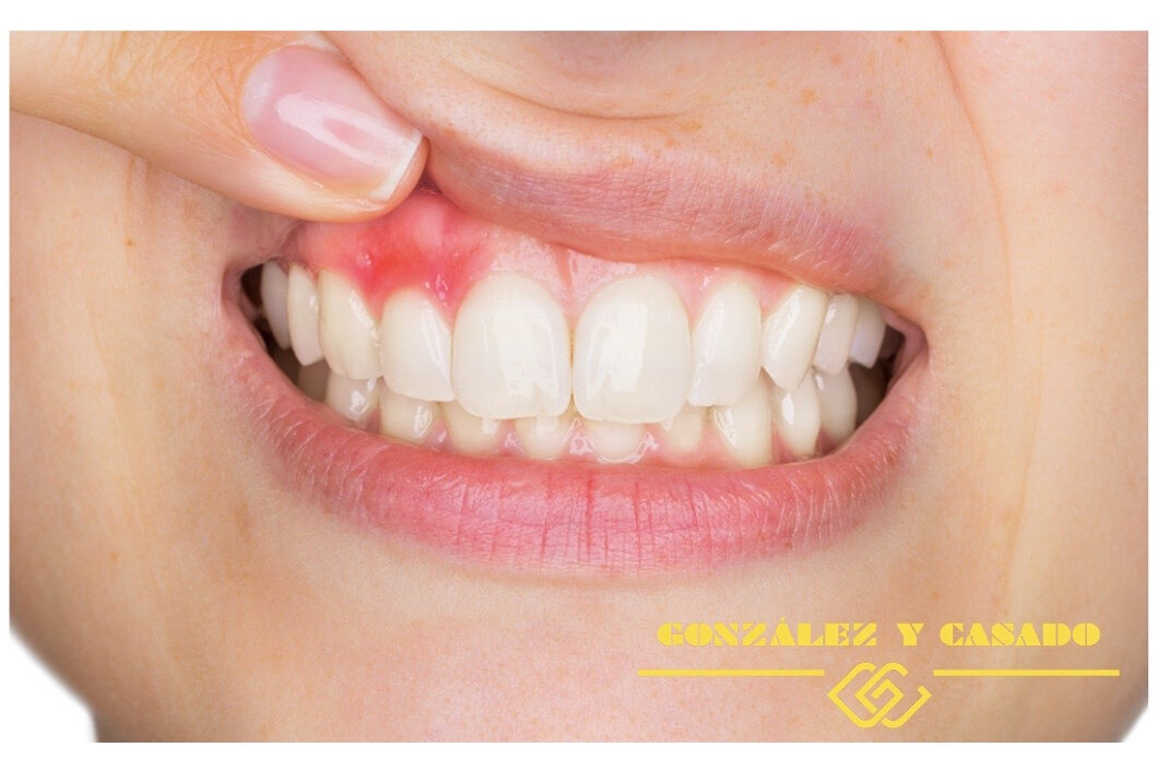 portada gingivitis con logo