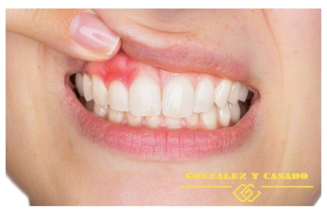 portada gingivitis con logo