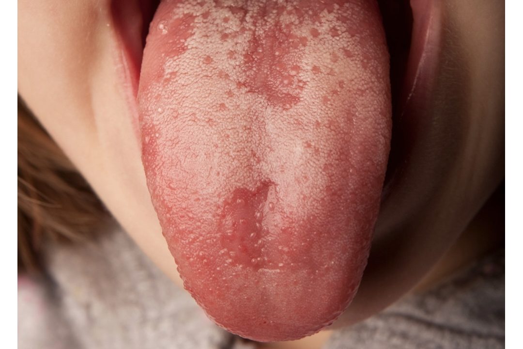 lengua covid portada lengua covid