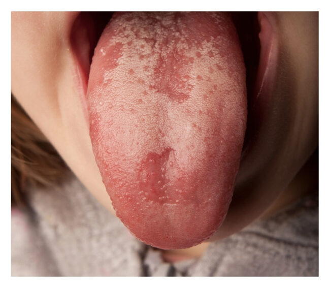 lengua covid portada lengua covid