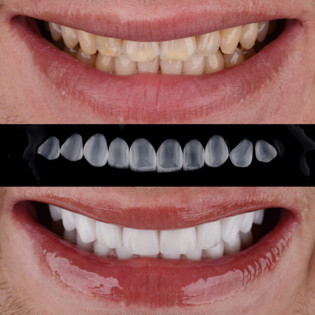 carillas dentales en madrid