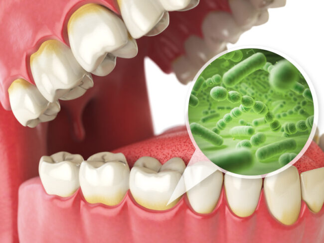 periodontitis-faq periodontitis y salud cardiovascular gonzález y casado madrid