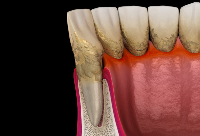 qué es la periodontitis