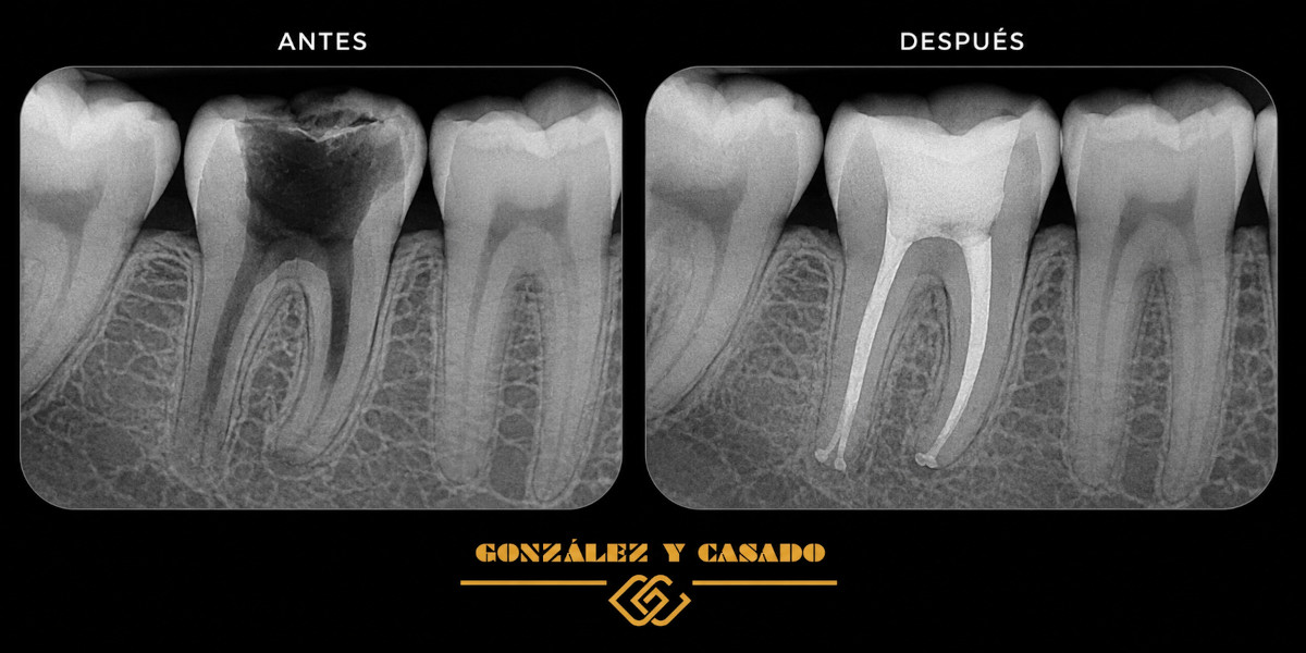 antes después de una endodoncia
