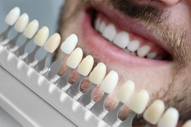 proceso de colocación de carillas dentales paso a paso