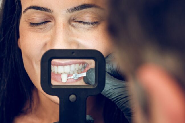 cuántas carillas dentales necesito