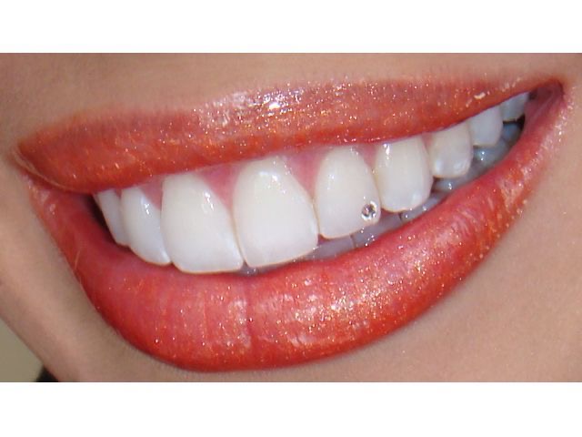 joyas dentales cristales