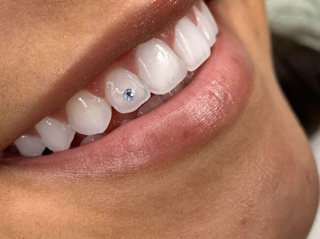 qué son las joyas dentales