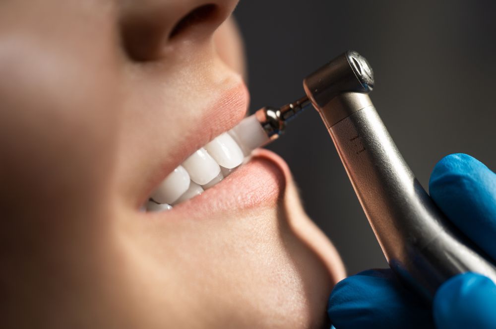 mejor limpieza dental en madrid centro