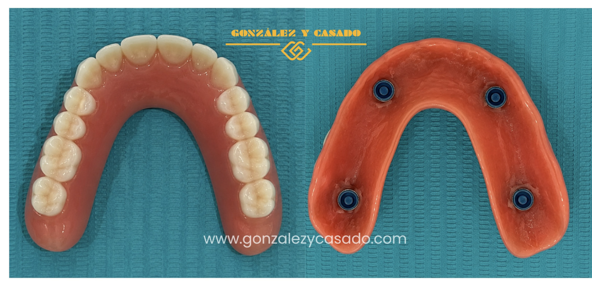 sobredentadura con implantes