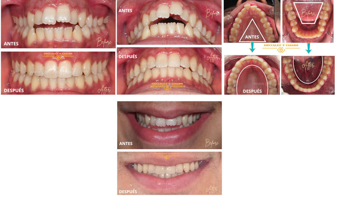 qué es la mordida abierta