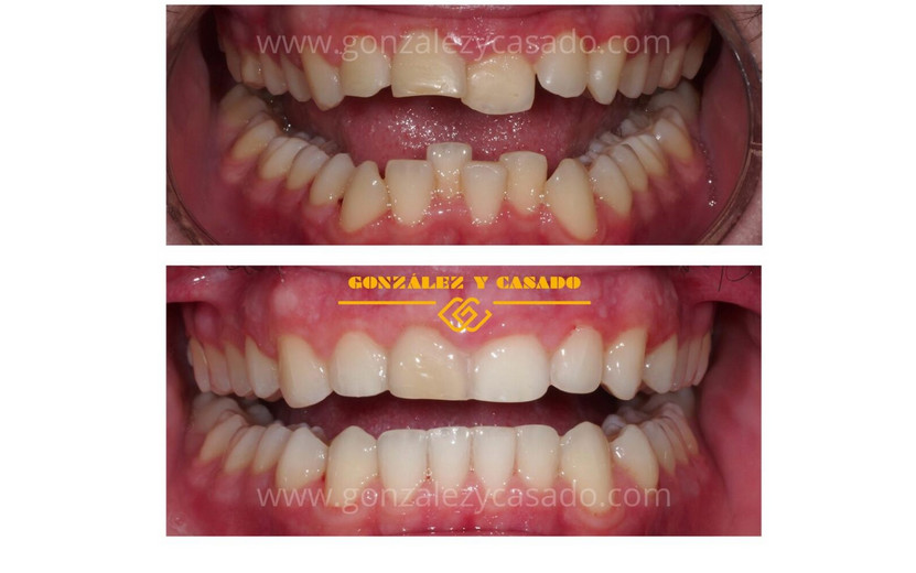 apiñamiento dental