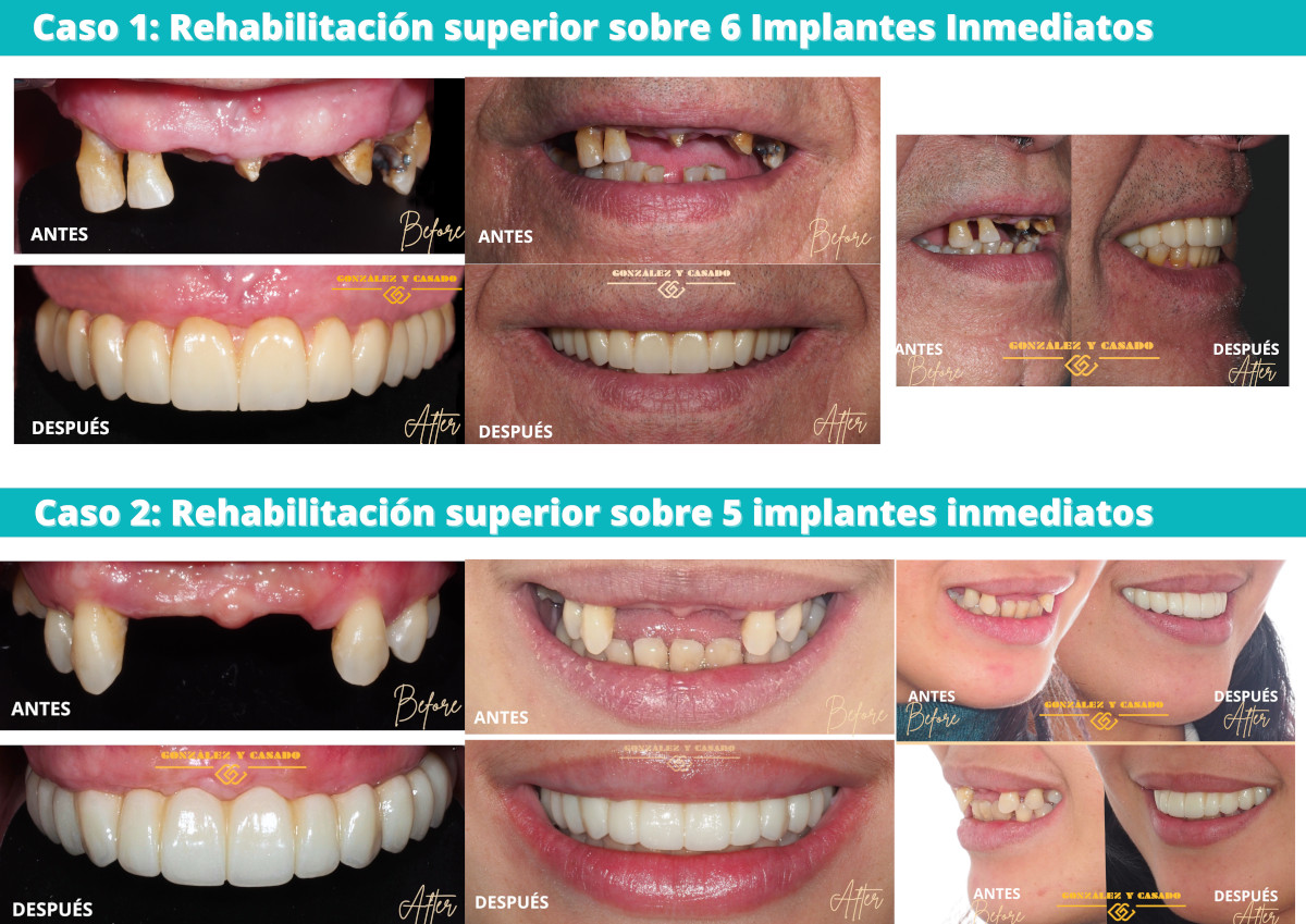 rehabilitación implantes inmediatos diferidos