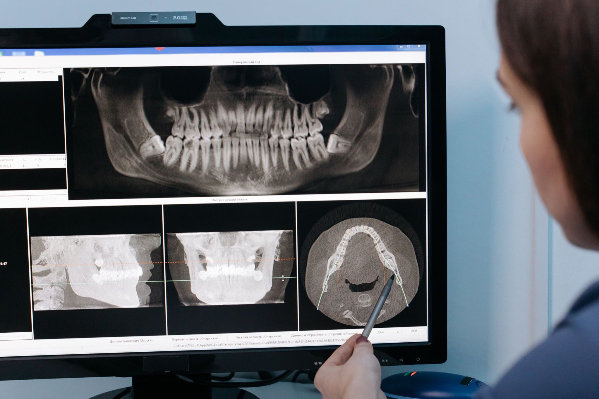 a qué edad se deben quitar las muelas del juicio