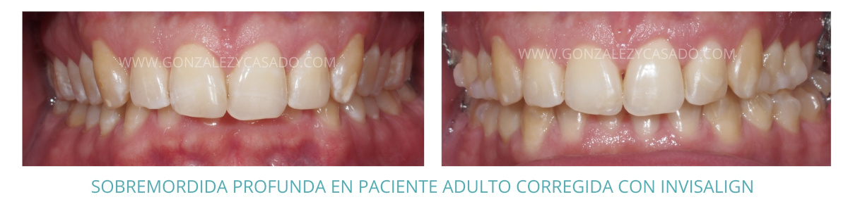 sobremordida