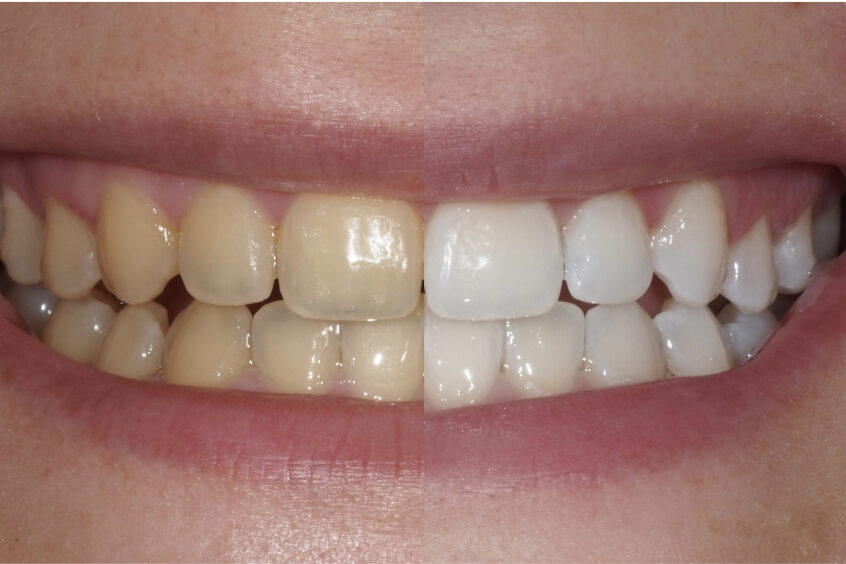 blanqueamiento dental profesional vs productos caseros