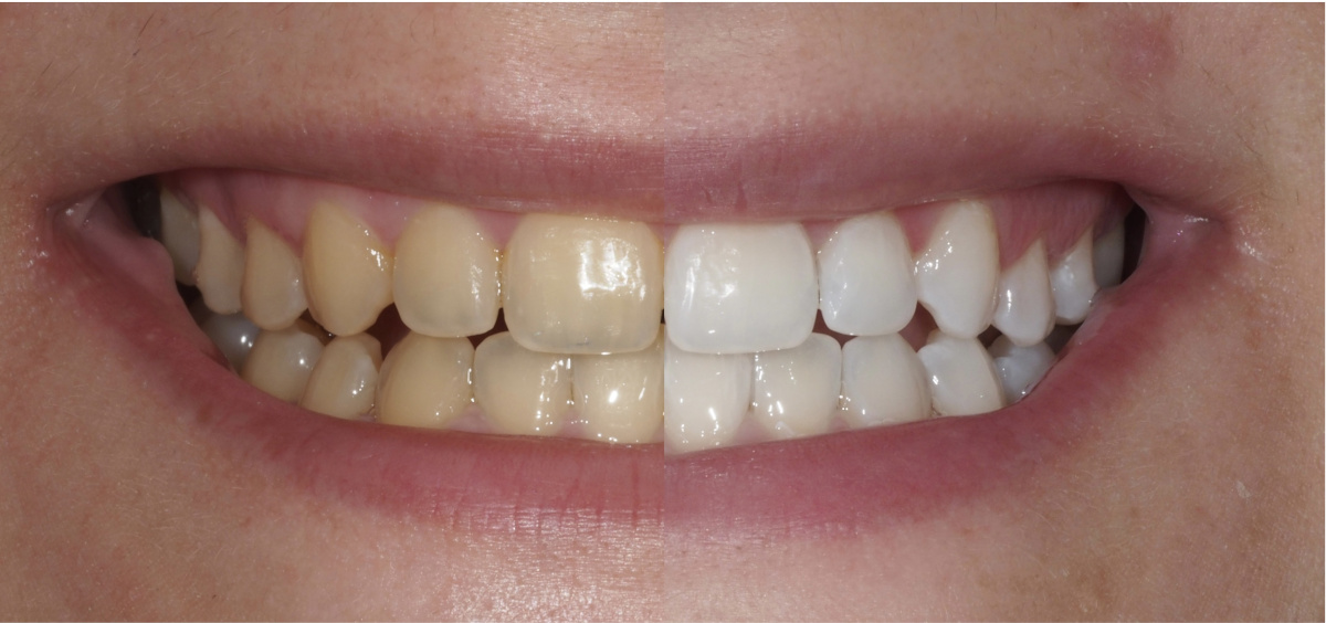 blanqueamiento dental profesional vs productos caseros