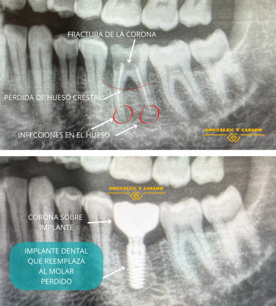 implante dental sin dolor