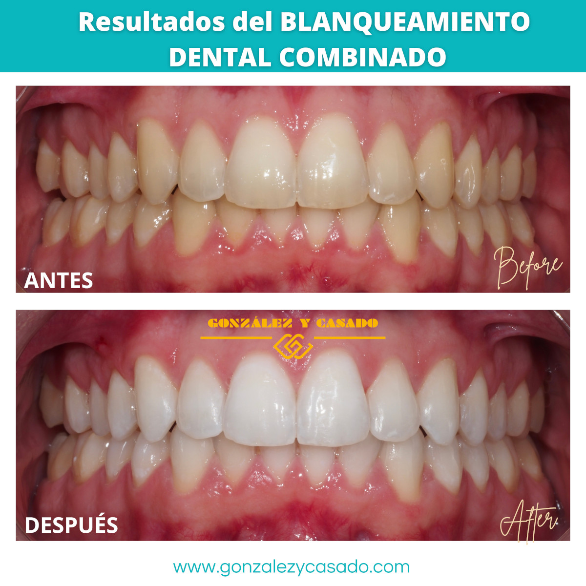 blanqueamiento dental combinado madrid