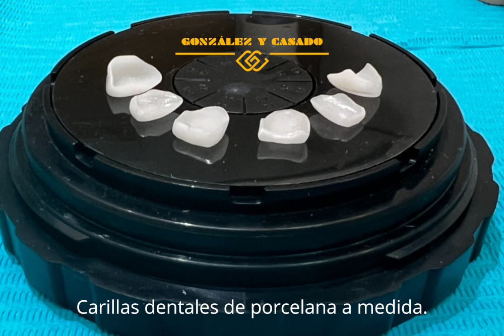 diferencias entre coronas y carillas dentales