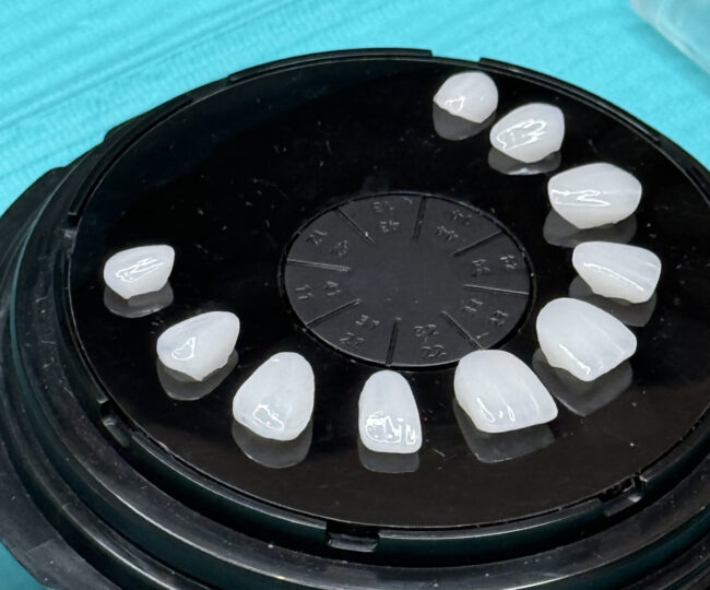 diferencias entre coronas y carillas