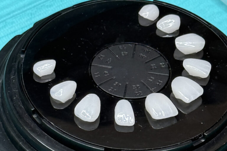 diferencias entre coronas y carillas