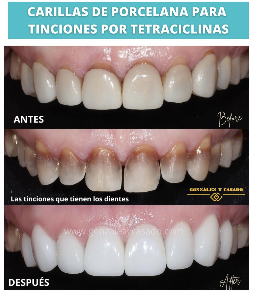 señales de que necesitas carillas dentales 