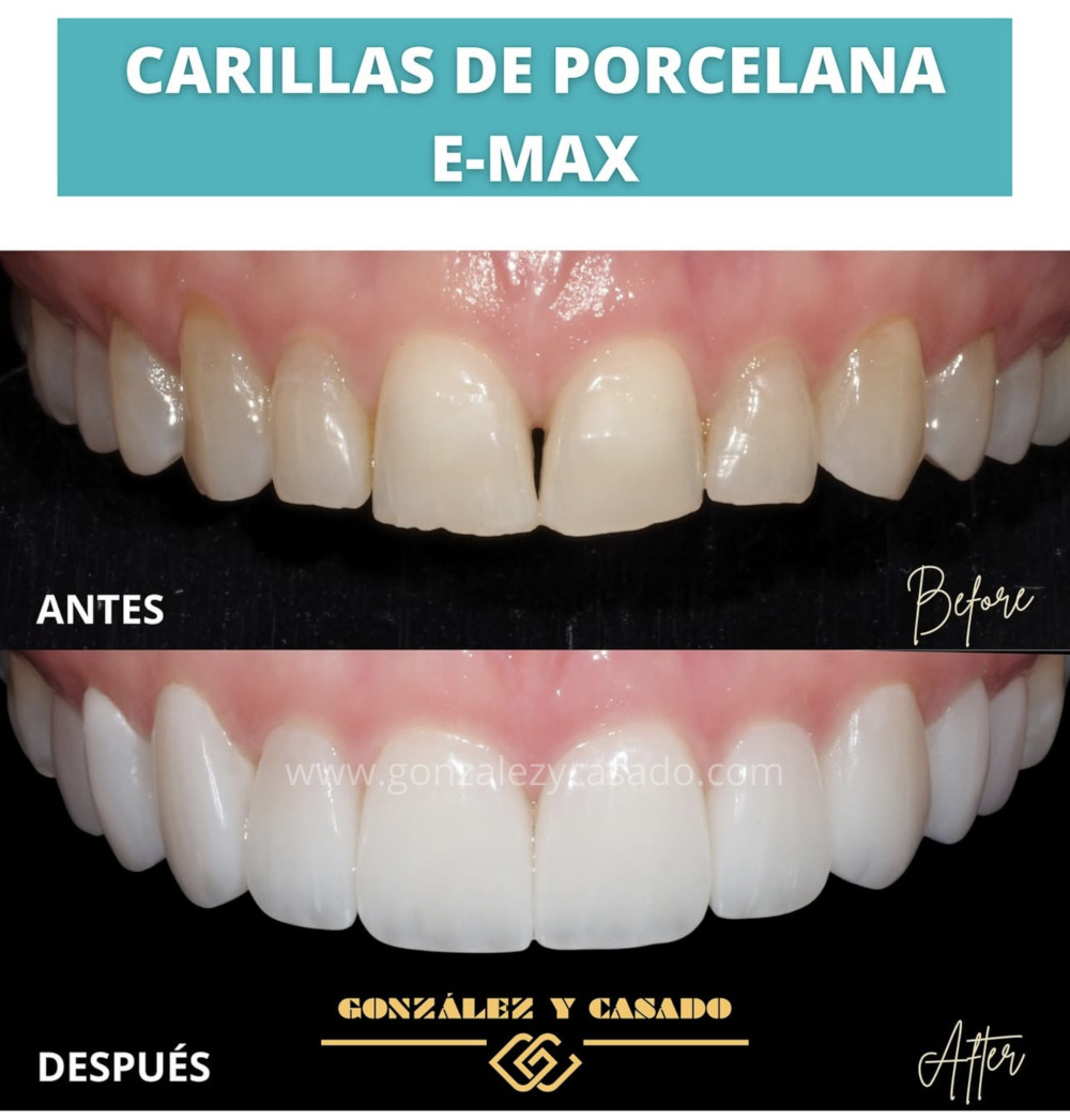 carillas dentales