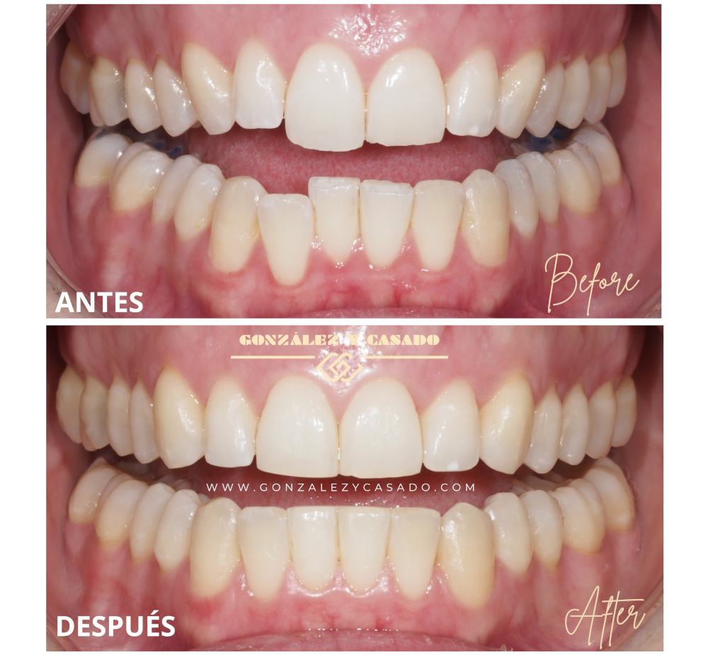 tratamiento ortodoncia invisible madrid