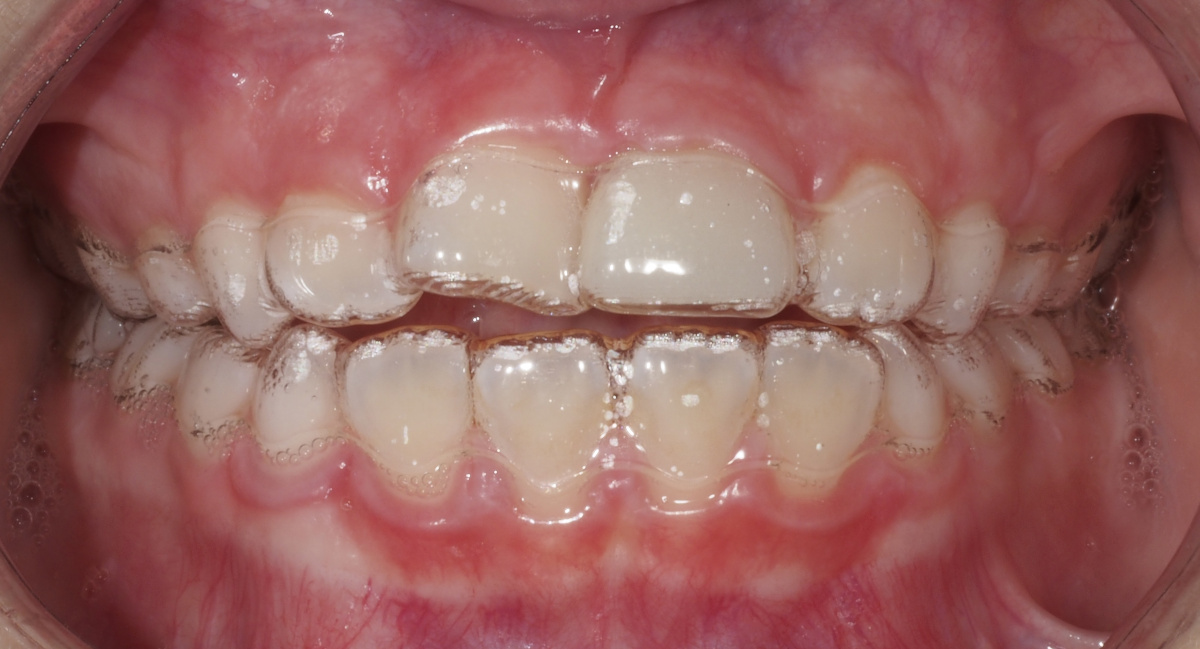 mordida abierta chuparse dedo