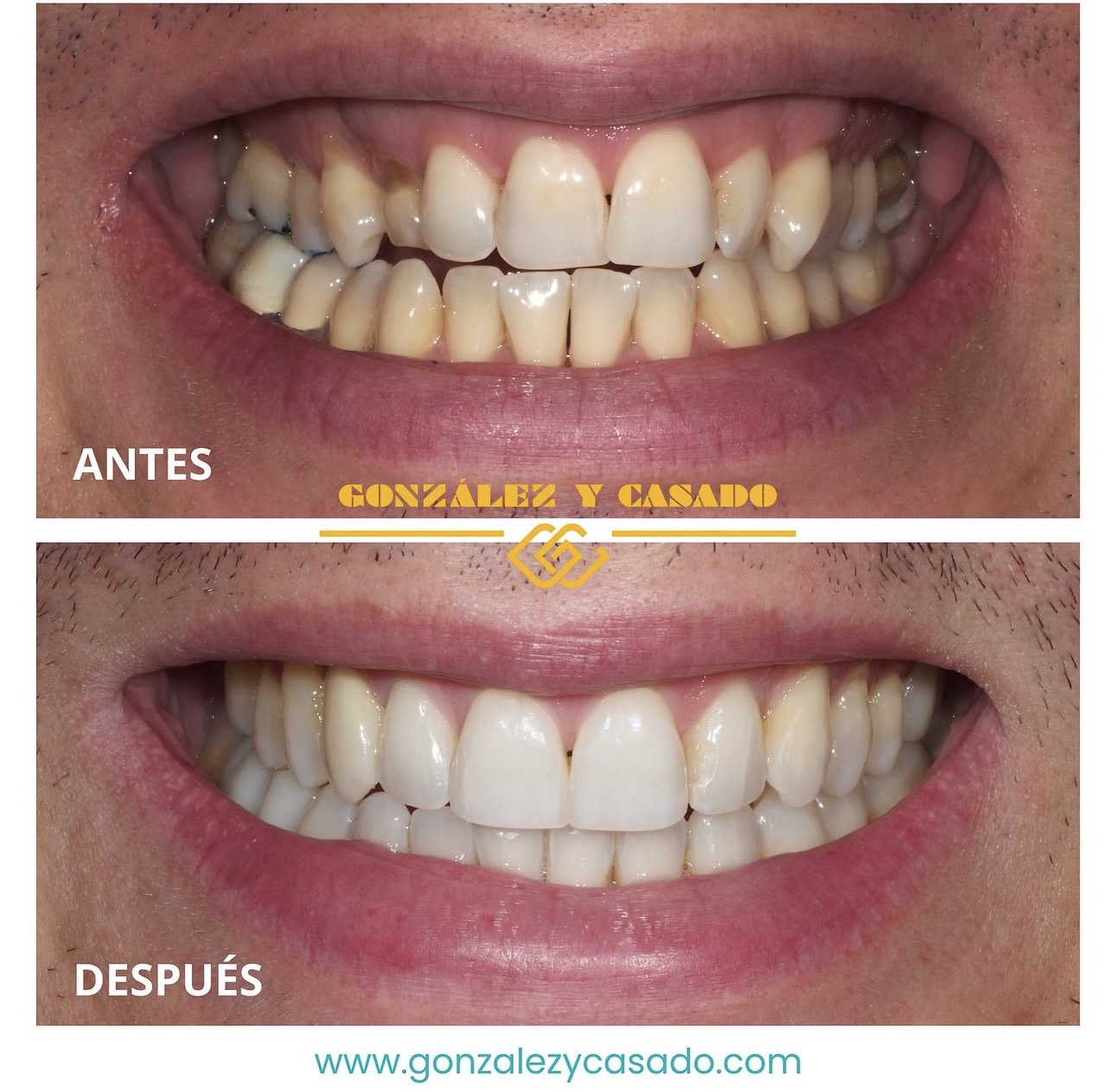 beneficios de tener los dientes alineados