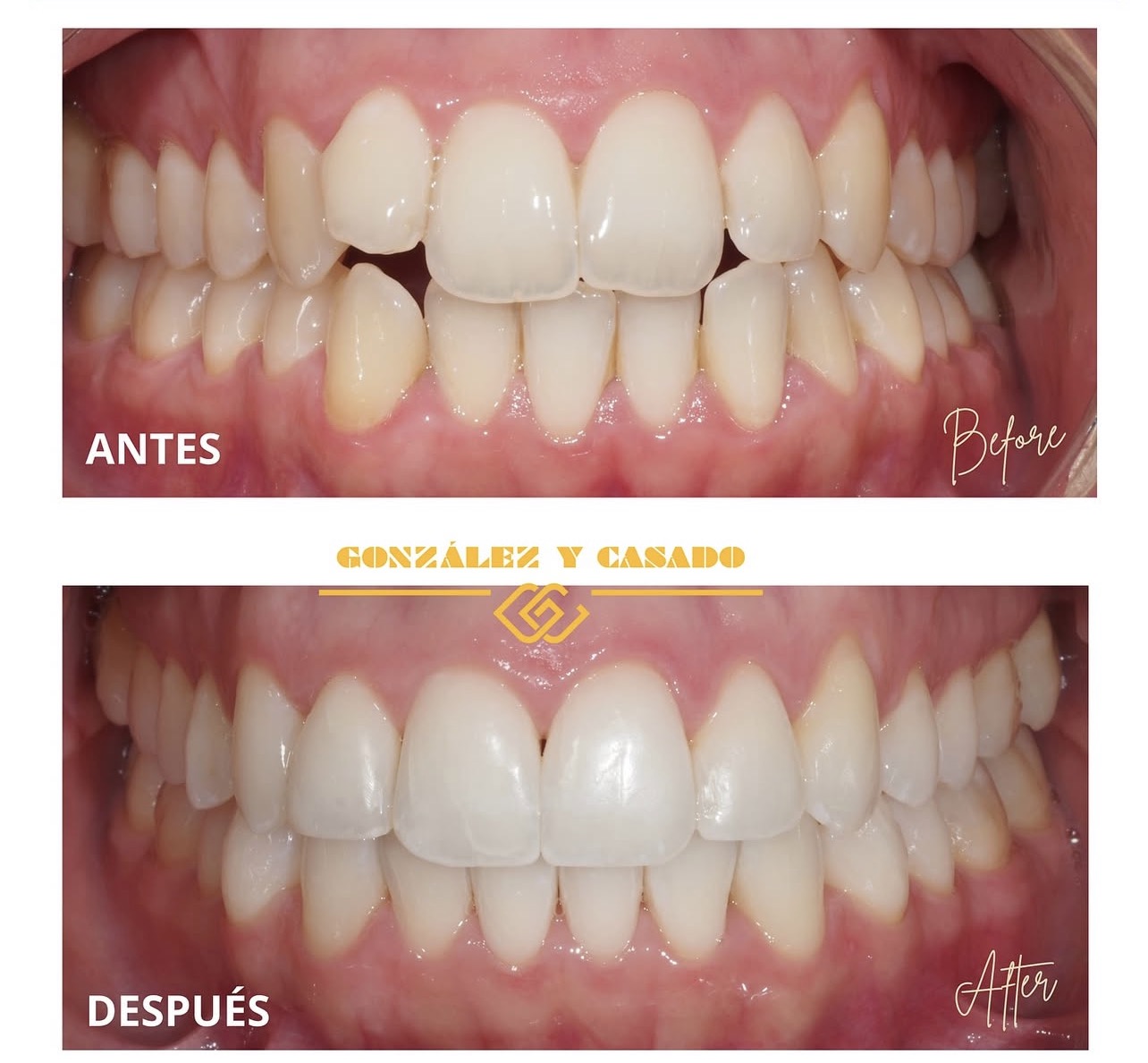 dentadura bonita corregida