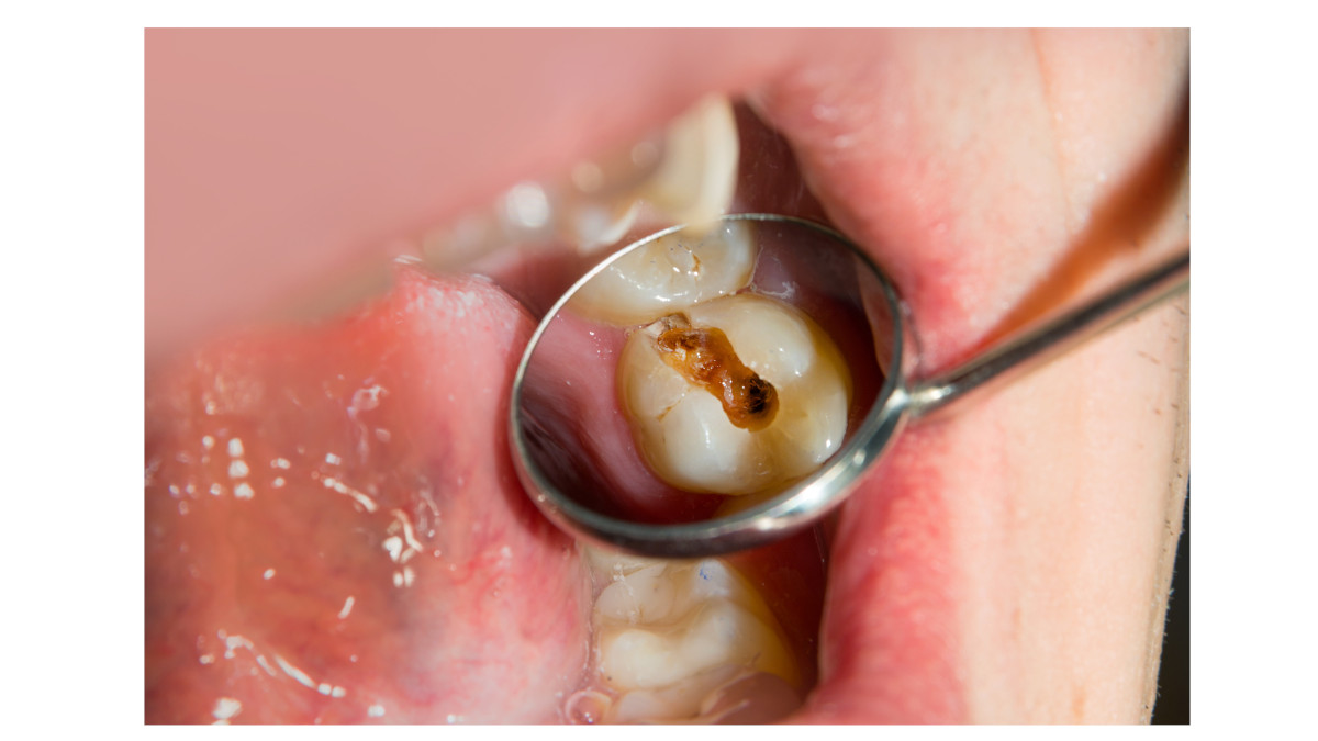 reconstrucción dental