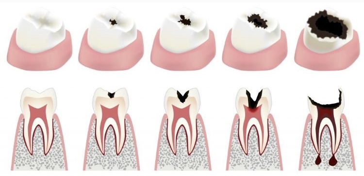 fases de la caries dental