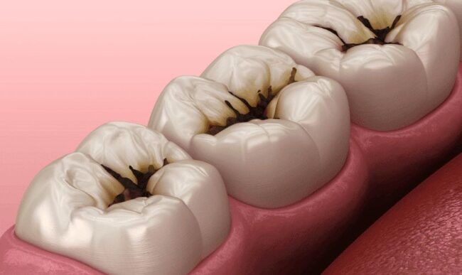 caries dental enfermedad más frecuente del mundo
