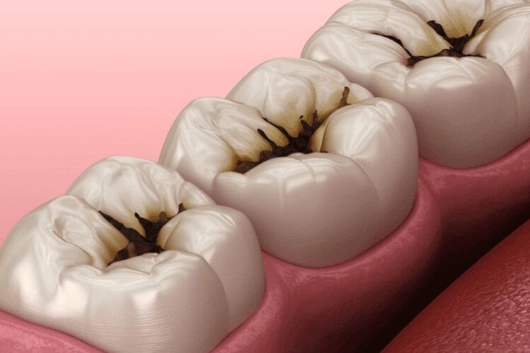 Portada blog caries dental caries dental enfermedad más frecuente del mundo