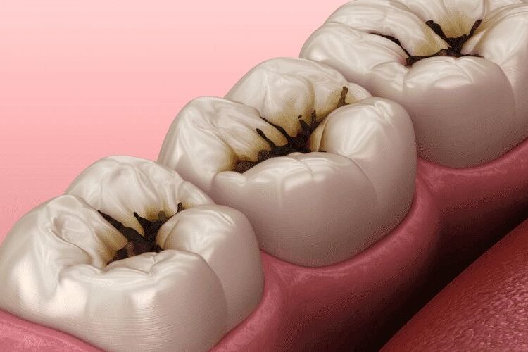 caries dental enfermedad más frecuente del mundo