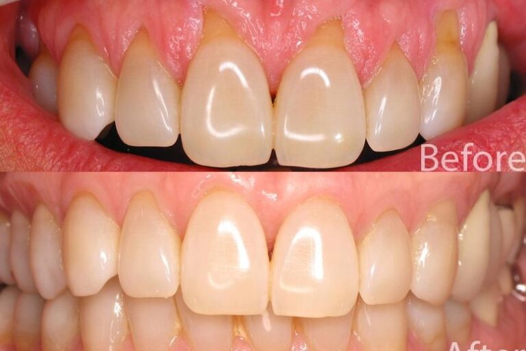 recesiones gingivales