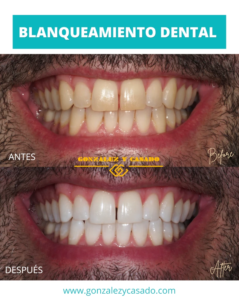 color normal delos dientes tonos