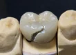 qué pasa si se rompe una corona dental