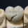 qué pasa si se rompe una corona dental