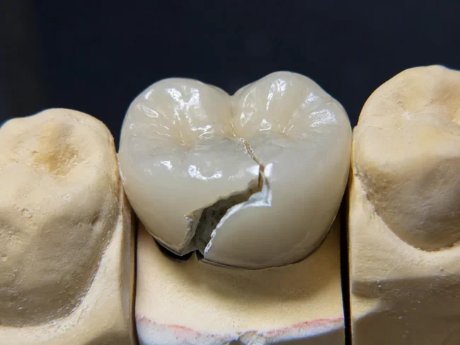 que-pasa-si-se-rompe-corona-dental qué pasa si se rompe una corona dental