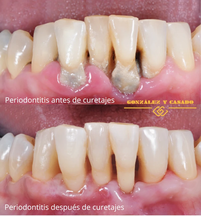gingivitis o periodontitis