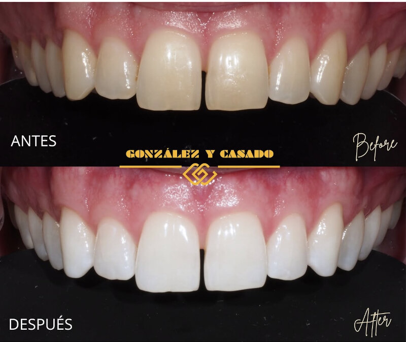 el blanqueamiento dental no daña tus dientes