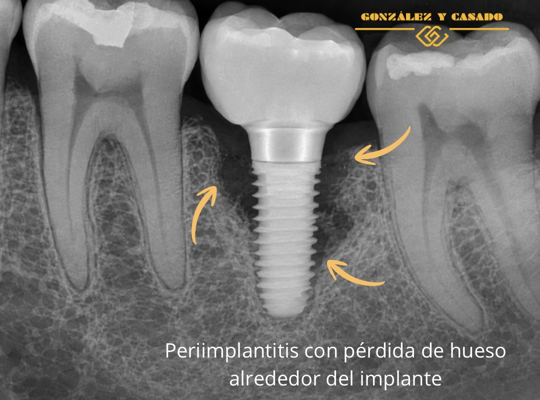 periimplantitis